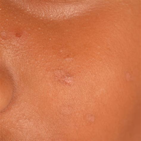 what are similar to scars